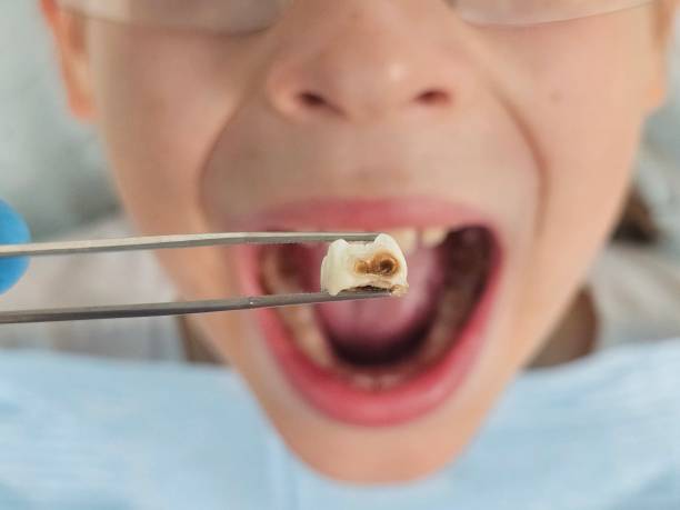 Best Knocked-Out Tooth Emergency  in Glen Ellyn, IL